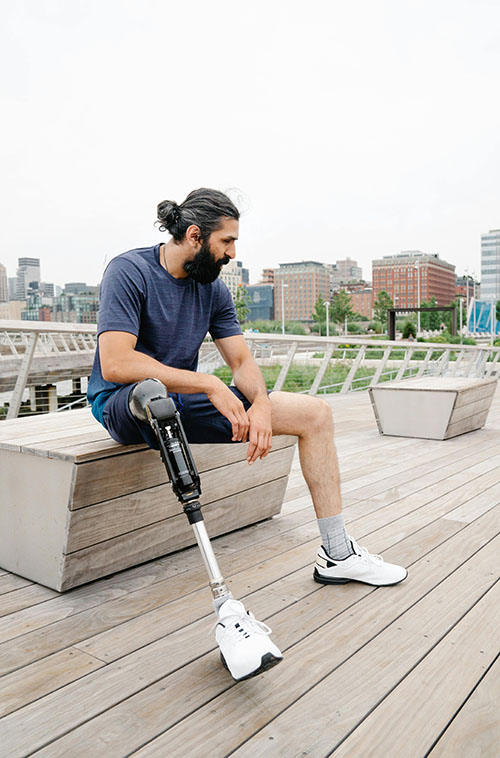 The Vital Role of the Residual Limb in Prosthetic Fitting and Customization